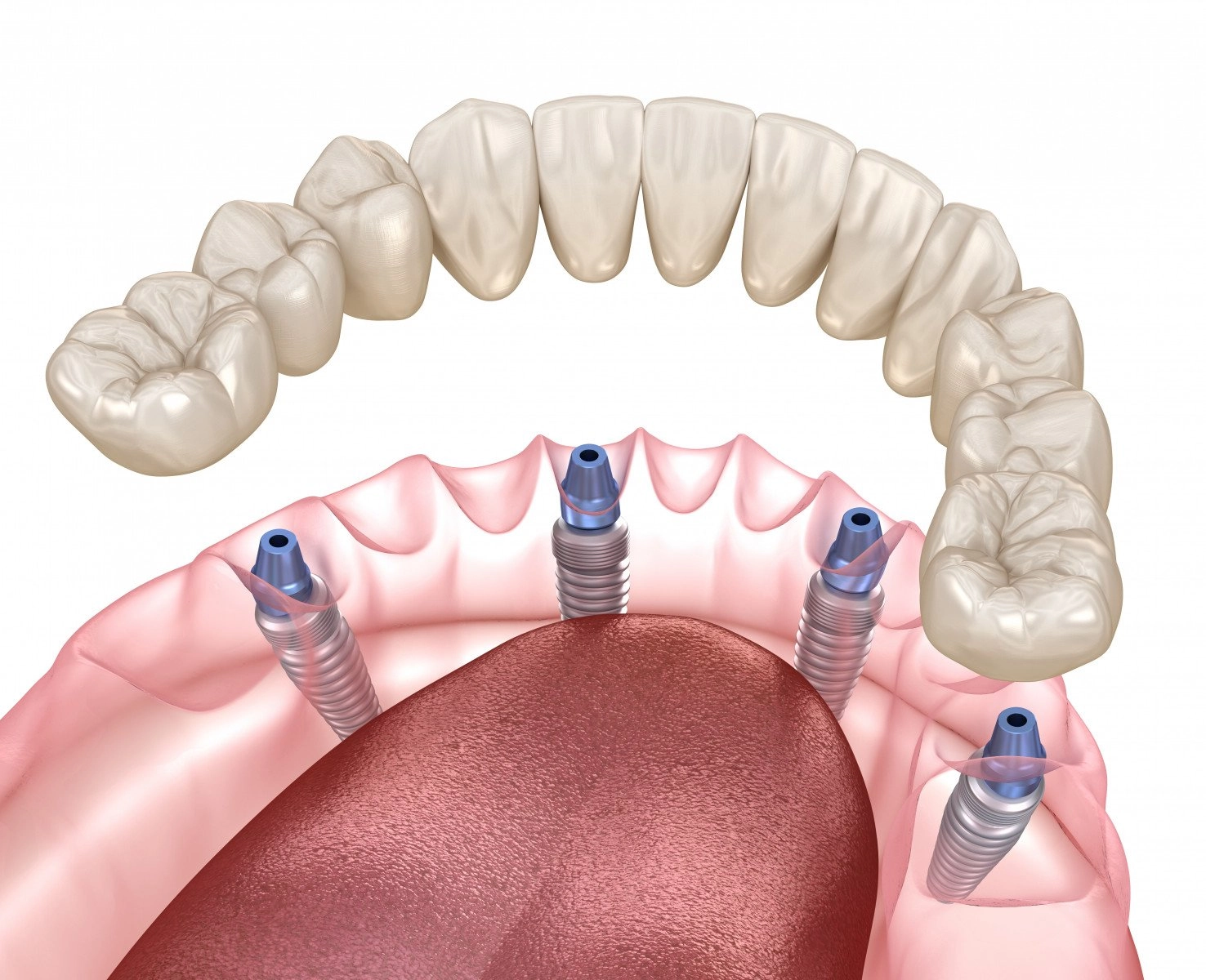 dental prosthesis